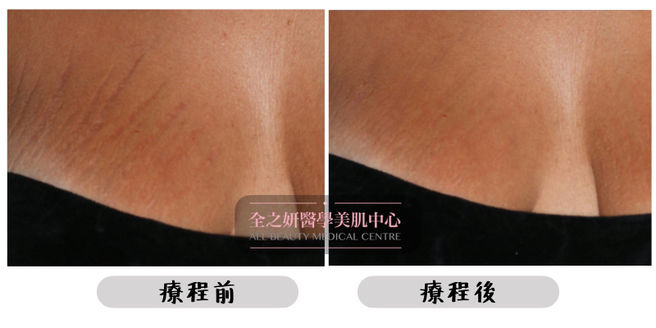 All Beauty全之妍 M22 強效淡化疤痕妊娠紋療程效果9.jpeg