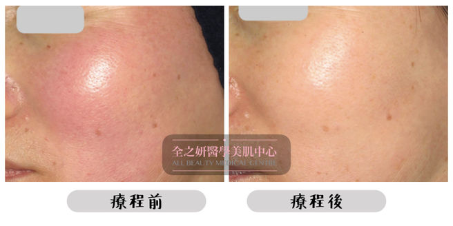 All Beauty全之妍 M22 紅血絲敏感泛紅玫瑰痤瘡療程效果8.jpeg