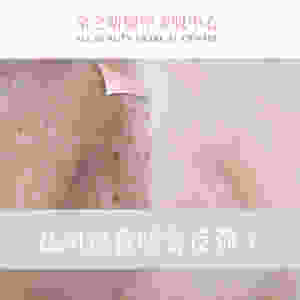 祛斑後會唔會反彈 打斑 激光打斑 激光去斑 全之妍 ALLBEAUTY