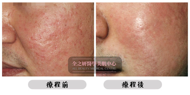 All Beauty全之妍 M22 改善粗大毛孔紋理療程效果1.jpeg