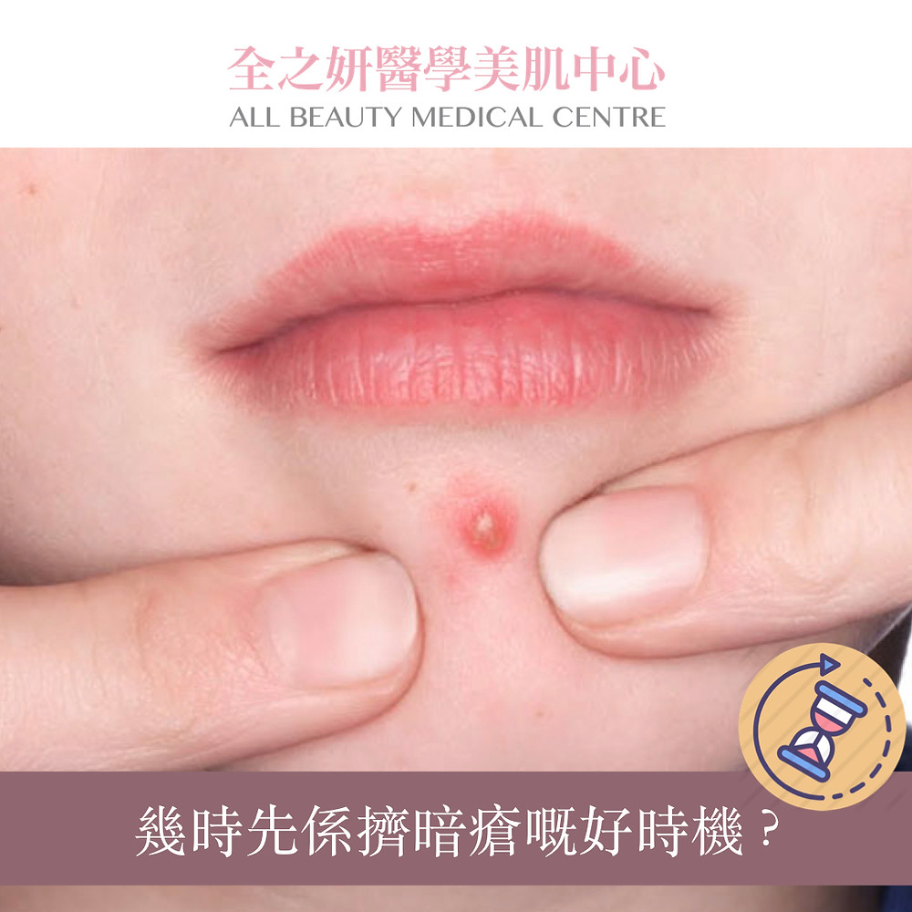 暗瘡皮膚 暗瘡 暗瘡肌 暗瘡護理 ALLBEAUTY 全之妍