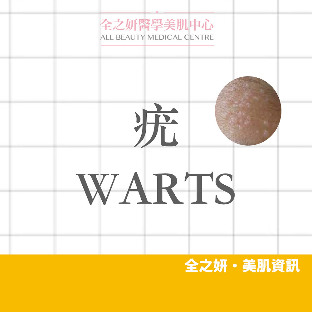 疣是什麼 雞眼 足部疣 二氧化碳激光脫疣 CO2 Laser脫疣 CO2 激光脫疣 冷凍治療 手部疣 扁平疣