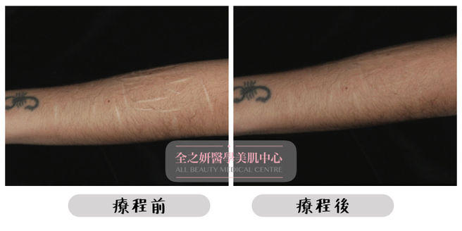 All Beauty全之妍 M22 強效淡化疤痕妊娠紋療程效果5.jpeg