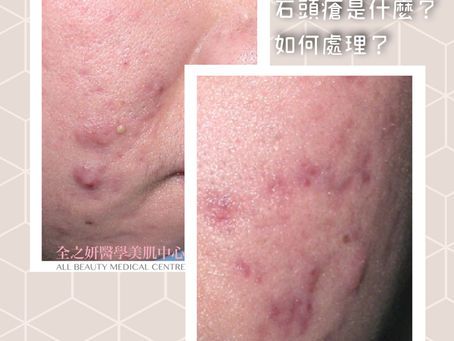石頭瘡是什麼?如何處理?
