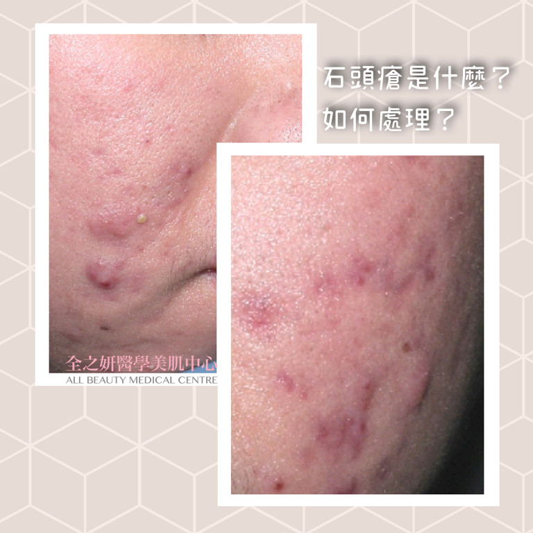 生暗瘡 暗瘡印 暗瘡凹凸洞 暗瘡皮膚 暗瘡 暗瘡肌 暗瘡護理 ALLBEAUTY 全之妍