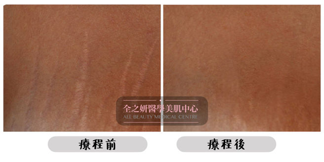 All Beauty全之妍 M22 強效淡化疤痕妊娠紋療程效果10.jpeg