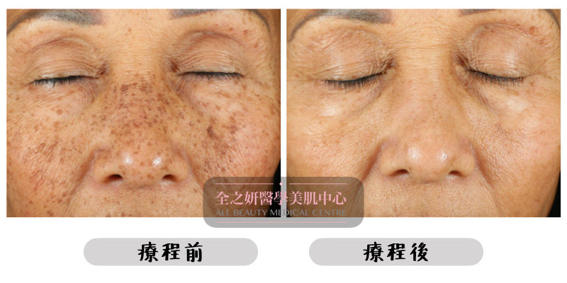 皮秒激光 皮秒蜂巢激光 Picosure Pro 祛斑 去斑 美白 洗紋身 收毛孔