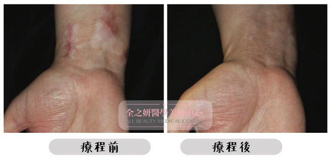 All Beauty全之妍 M22 強效淡化疤痕妊娠紋療程效果3.jpeg