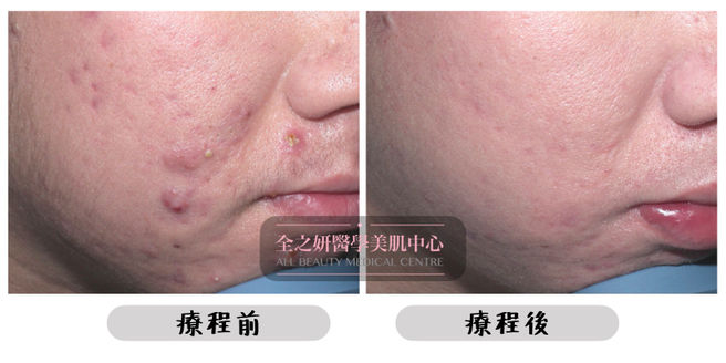 All Beauty全之妍 M22 暗瘡療程效果4.jpeg
