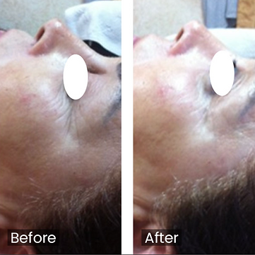 Wishpro女神肌智能膠囊療程 FDA認證 BEFORE AFTER 香港美容 All Beauty 全之妍醫美肌中心