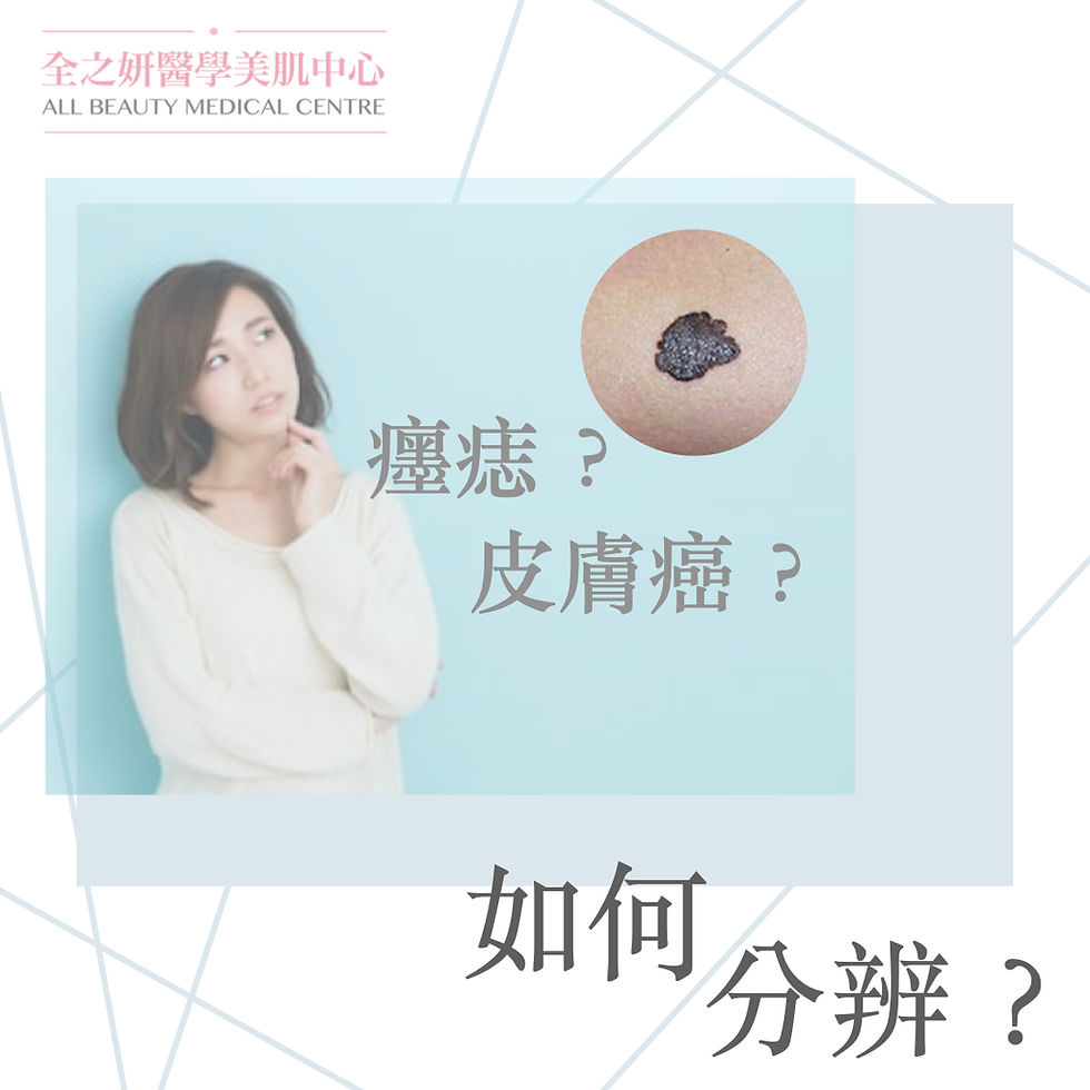 是墨痣？還是皮膚癌？