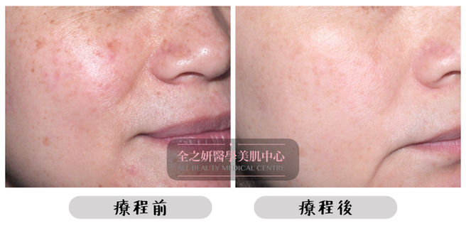 All Beauty全之妍 M22 色斑療程效果5.jpeg