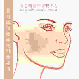 荷爾蒙斑係咪特別難處理 激光打斑 全之妍 ALLBEAUTY