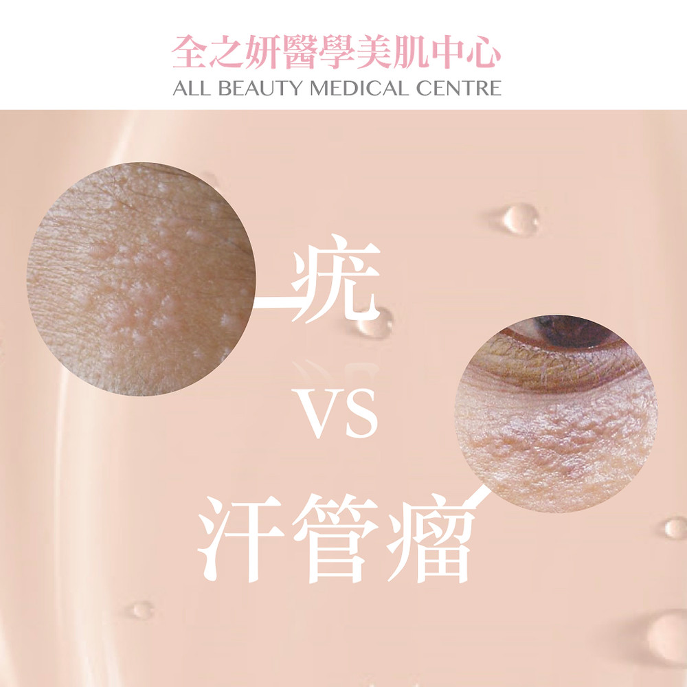 脫疣 激光脫疣 二氧化碳激光脫疣