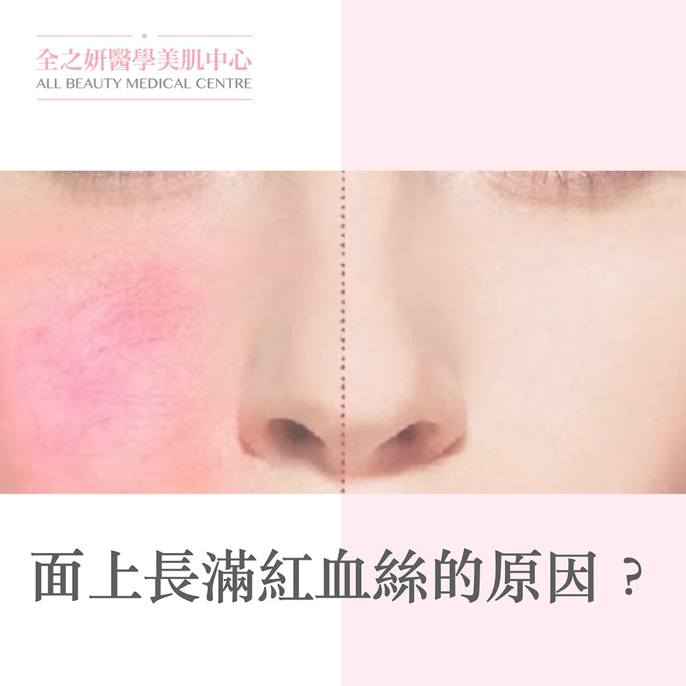紅血絲 皮膚敏感 敏感皮膚 敏感肌 Lumenis M22 完美脈衝光