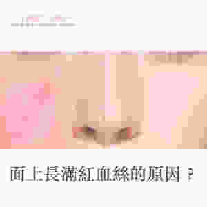 紅血絲 皮膚敏感 敏感皮膚 敏感肌 Lumenis M22 完美脈衝光