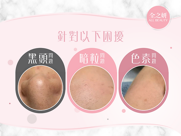 黑頭 暗粒 色素 Allbeauty_Aquapeel_Aquaxpeel煥膚療程 非一般的AQUA PEEL