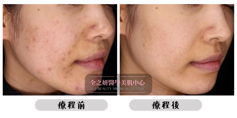 皮秒激光 淡化痘印 提亮膚色 Picosure Pro