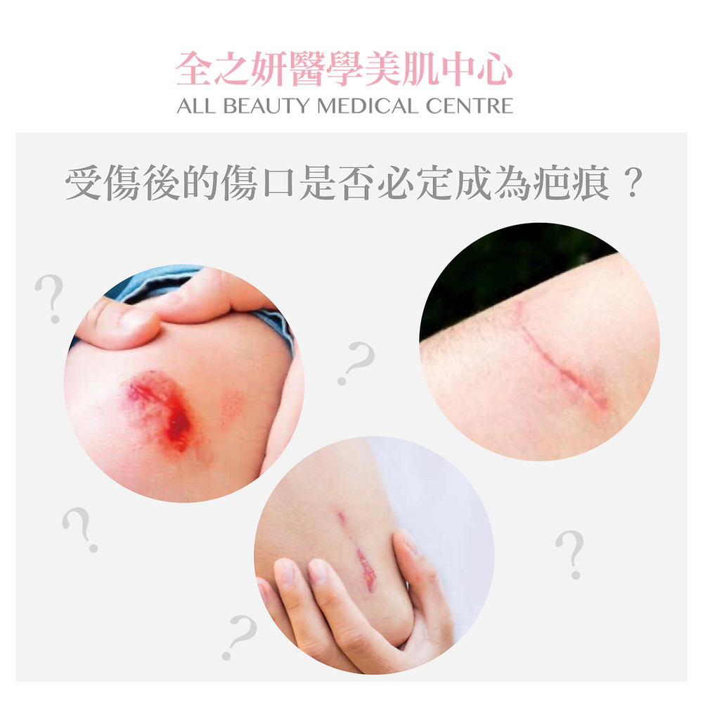 Scar 疤痕 增生性疤痕 凹陷性疤痕 蟹足腫 疤痕療程 疤痕針 溶疤針