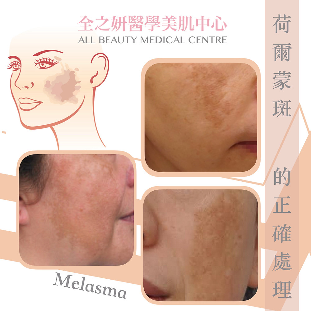 去斑 打斑 色斑 雀斑 咖啡斑 荷爾蒙斑 皮秒打斑 ALLBEAUTY 全之妍