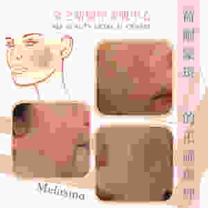 去斑 打斑 色斑 雀斑 咖啡斑 荷爾蒙斑 皮秒打斑 ALLBEAUTY 全之妍