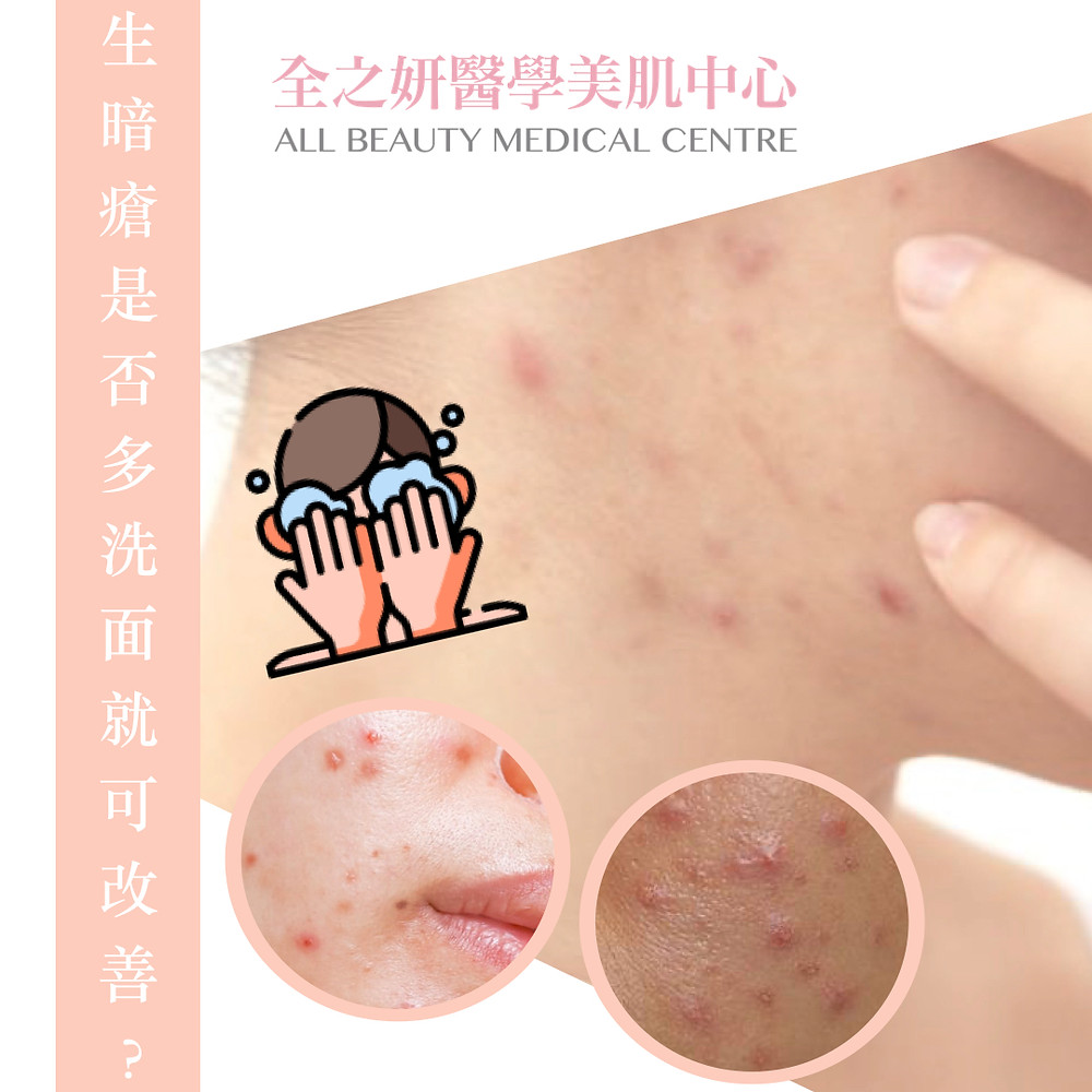 暗瘡皮膚 暗瘡 暗瘡肌 暗瘡護理 ALLBEAUTY 全之妍