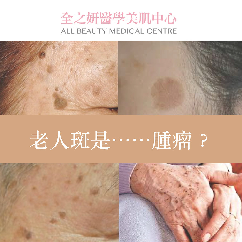 去斑 打斑 色斑 雀斑 老人斑 咖啡斑 荷爾蒙斑 皮秒打斑 ALLBEAUTY 全之妍