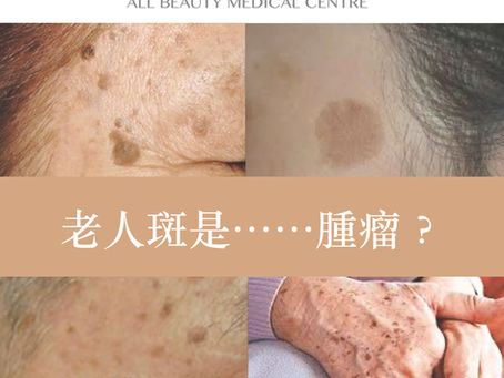 老人斑是腫瘤 ?