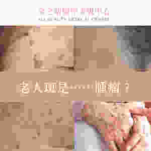 去斑 打斑 色斑 雀斑 老人斑 咖啡斑 荷爾蒙斑 皮秒打斑 ALLBEAUTY 全之妍
