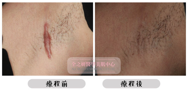 All Beauty全之妍 M22 強效淡化疤痕妊娠紋療程效果6.jpeg