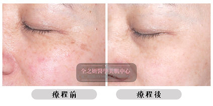 全之妍醫學美肌中心 All Beauty Medical Centre 提供細紋皺紋 療程 可有效 去紋 淡紋 減淡紋理 減淡細紋 Lumenis M22 OPT™ 完美脈衝光去紋理療程 Lumenis M22 ResurFX™ 撫平紋理肌膚重建療程 Dermafusion 無針水光槍之淡紋療程 Ultra V Lift 無針埋線療程 肉毒桿菌素A型去紋療程 Dysport Botox AMTS注滲療程