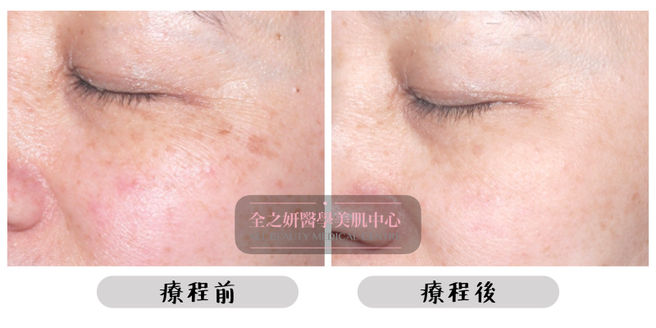 All Beauty全之妍 M22 改善粗大毛孔紋理療程效果4.jpeg