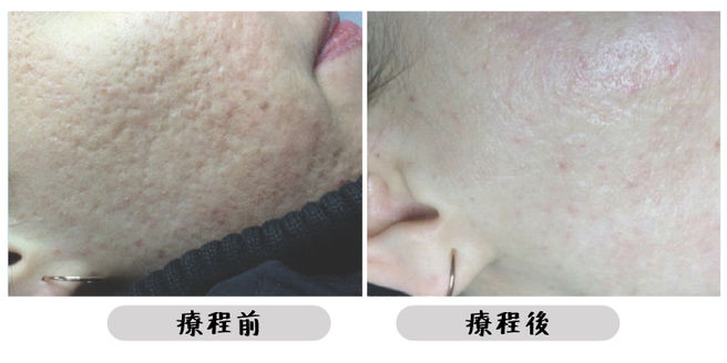 All Beauty全之妍 M22 暗瘡療程效果6.jpeg