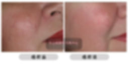 Rosacea 玫瑰痤瘡 M22 Excel V V-beam 玫瑰痤瘡忌口 玫瑰痤瘡根治