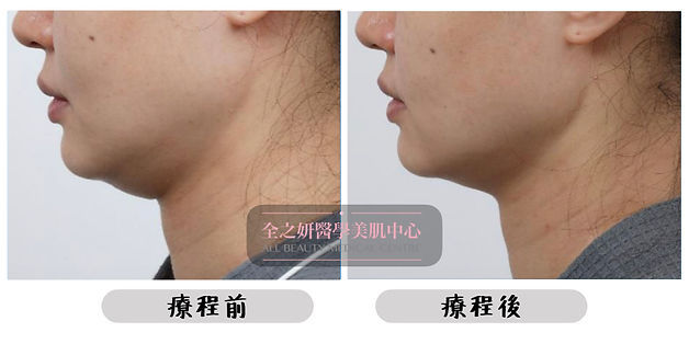 Before After MPT.001.jpeg