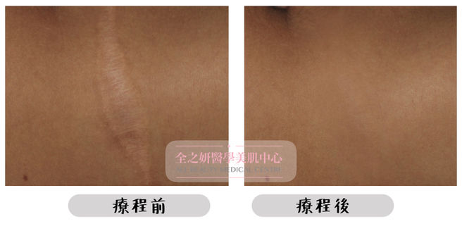 All Beauty全之妍 M22 強效淡化疤痕妊娠紋療程效果2.jpeg