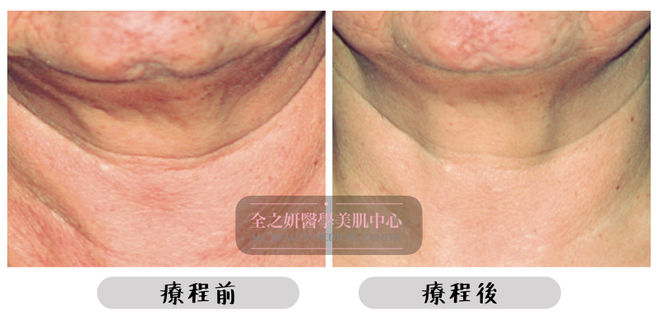 All Beauty全之妍 M22 改善粗大毛孔紋理療程效果7.jpeg