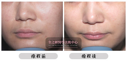 All Beauty 全之妍醫學美肌中心提供 美白 嫰膚 激光 果酸 療程 改善 泛黃 暗啞 膚色不均
