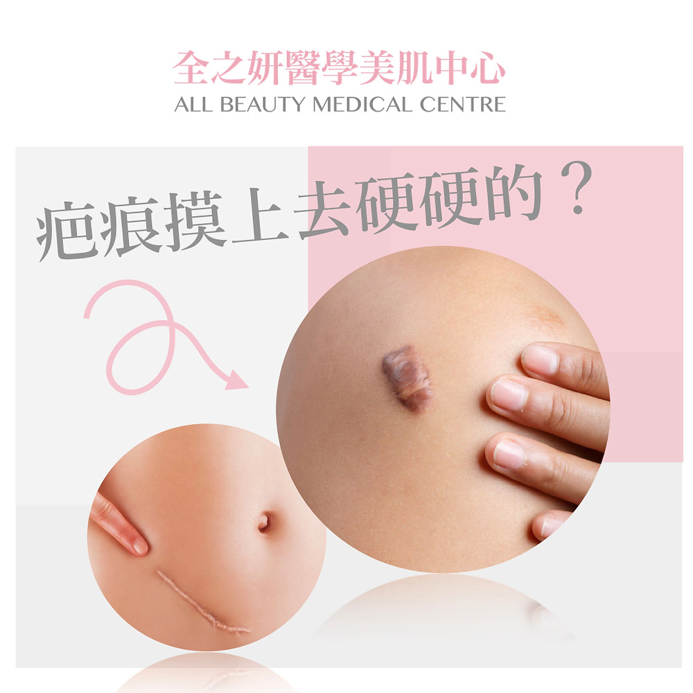 Scar 疤痕 增生性疤痕 凹陷性疤痕 蟹足腫 疤痕療程 疤痕針 溶疤針