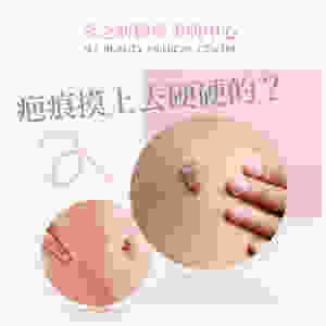Scar 疤痕 增生性疤痕 凹陷性疤痕 蟹足腫 疤痕療程 疤痕針 溶疤針