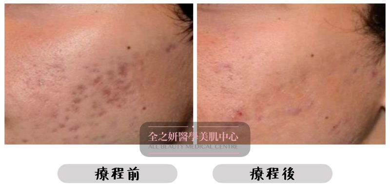 皮秒激光 改善凹凸洞和痘疤 Picosure Pro