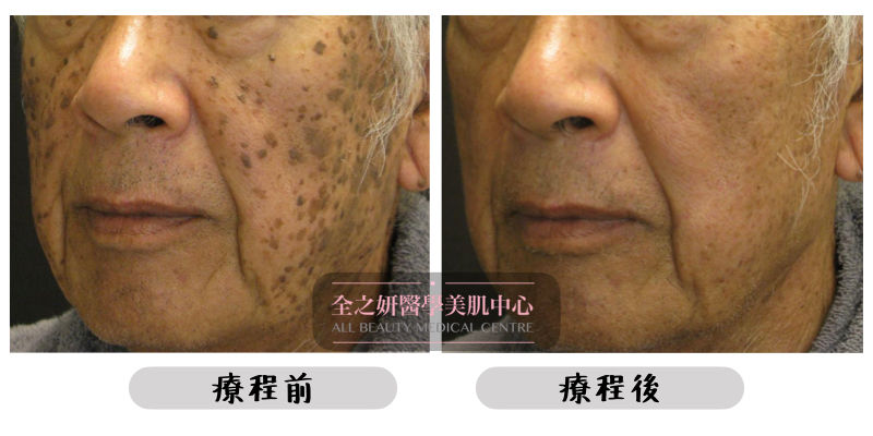 前後相 皮秒激光 皮秒蜂巢激光 Picosure Pro 祛斑 去斑 美白 洗紋身 收毛孔