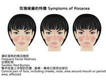 玫瑰痤瘡特徵有哪些?玫瑰痤瘡初期症狀、成因&治療方法詳解