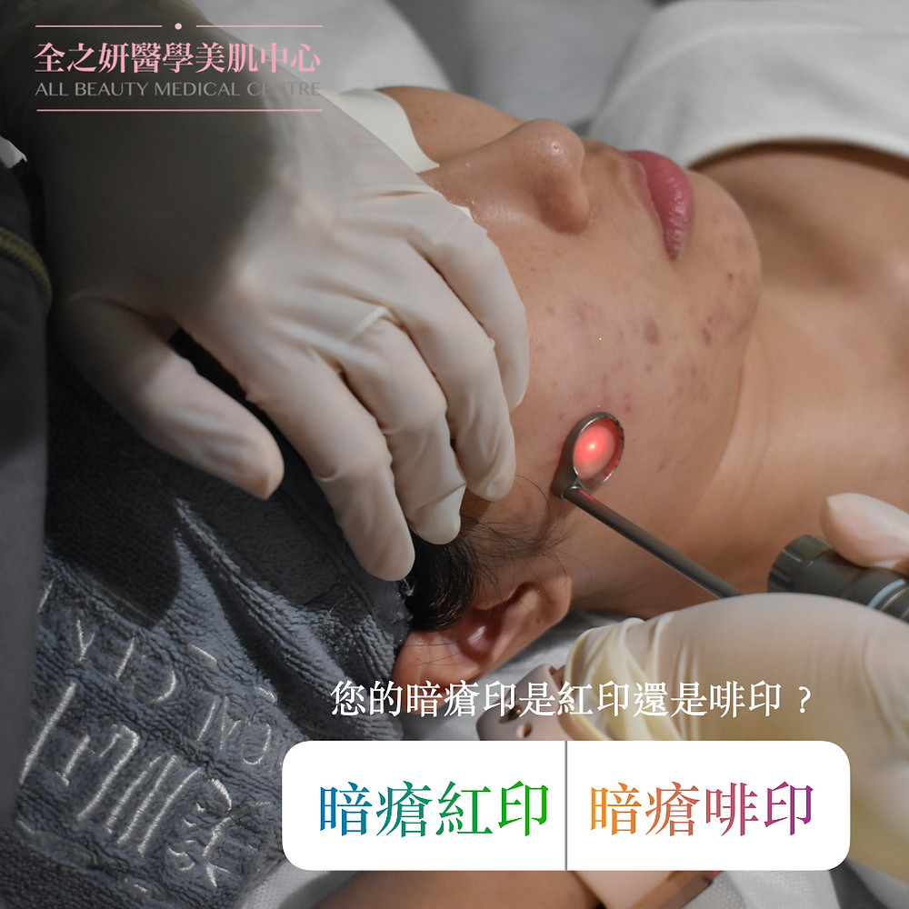 生暗瘡 暗瘡印 暗瘡凹凸洞 暗瘡皮膚 暗瘡 暗瘡肌 暗瘡護理 ALLBEAUTY 全之妍