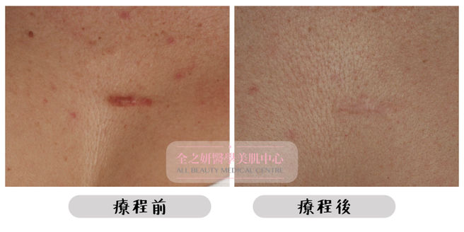 All Beauty全之妍 M22 強效淡化疤痕妊娠紋療程效果4.jpeg