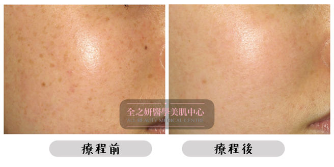 All Beauty全之妍 M22 色斑療程效果6.jpeg