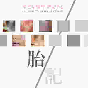 胎記係咪同其他斑一樣可以靠激光療程去除 激光打斑 激光打胎記 全之妍 ALLBEAUTY