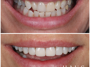 Airflow Therapy: Dental Hygiene Treatment – Understanding Its Need and Benefits