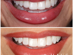 Tooth Restoration: Understanding the Different Types of Procedures, Needs, and Benefits