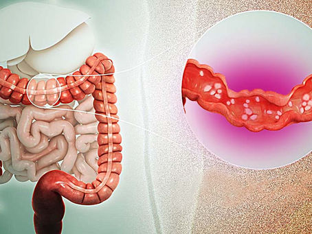 Chữa trị viêm đại tràng mãn tính